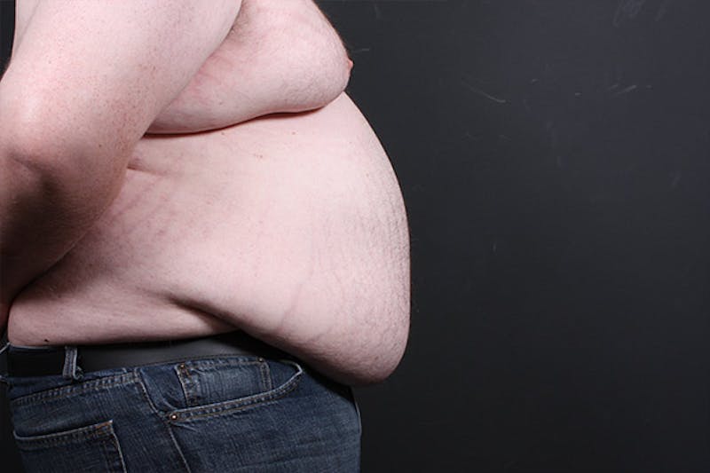 Liposuction Before & After Gallery - Patient 141841 - Image 5