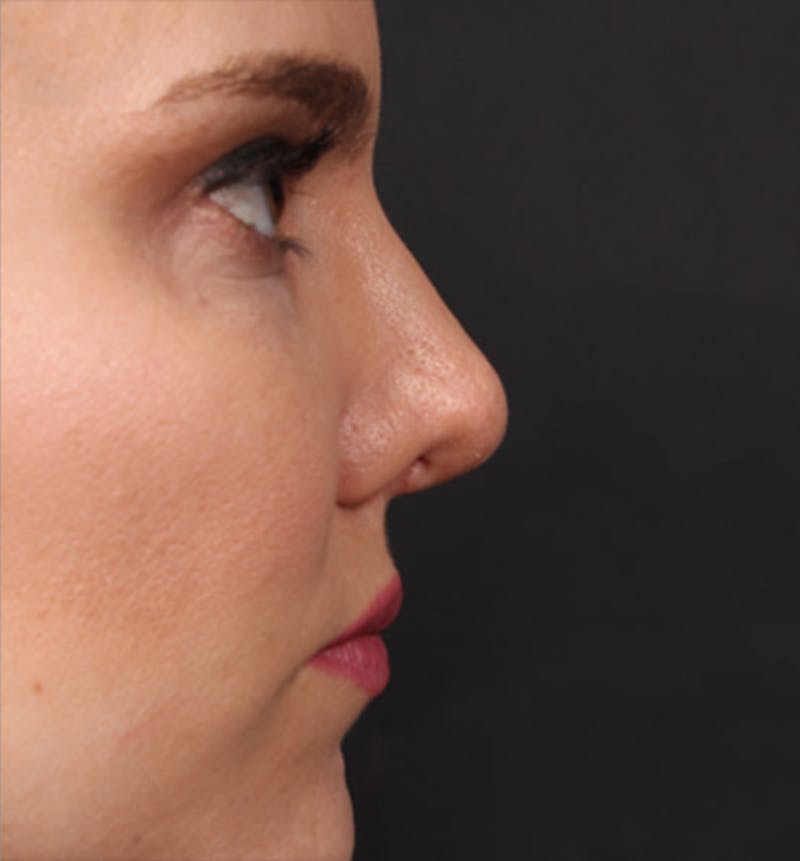 Rhinoplasty Before & After Gallery - Patient 377801 - Image 8