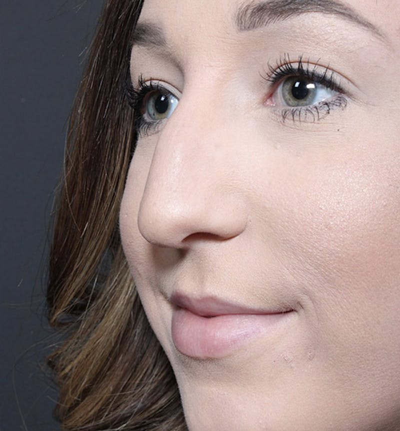 Rhinoplasty Before & After Gallery - Patient 366808 - Image 1