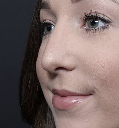 Rhinoplasty Before & After Gallery - Patient 366808 - Image 2