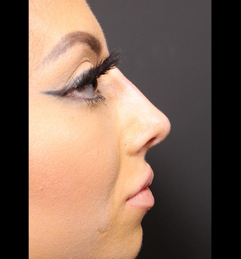 Non-Surgical Rhinoplasty Before & After Gallery - Patient 131196 - Image 10