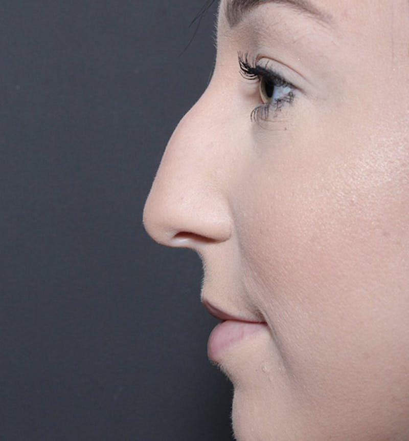 Rhinoplasty Before & After Gallery - Patient 366808 - Image 5
