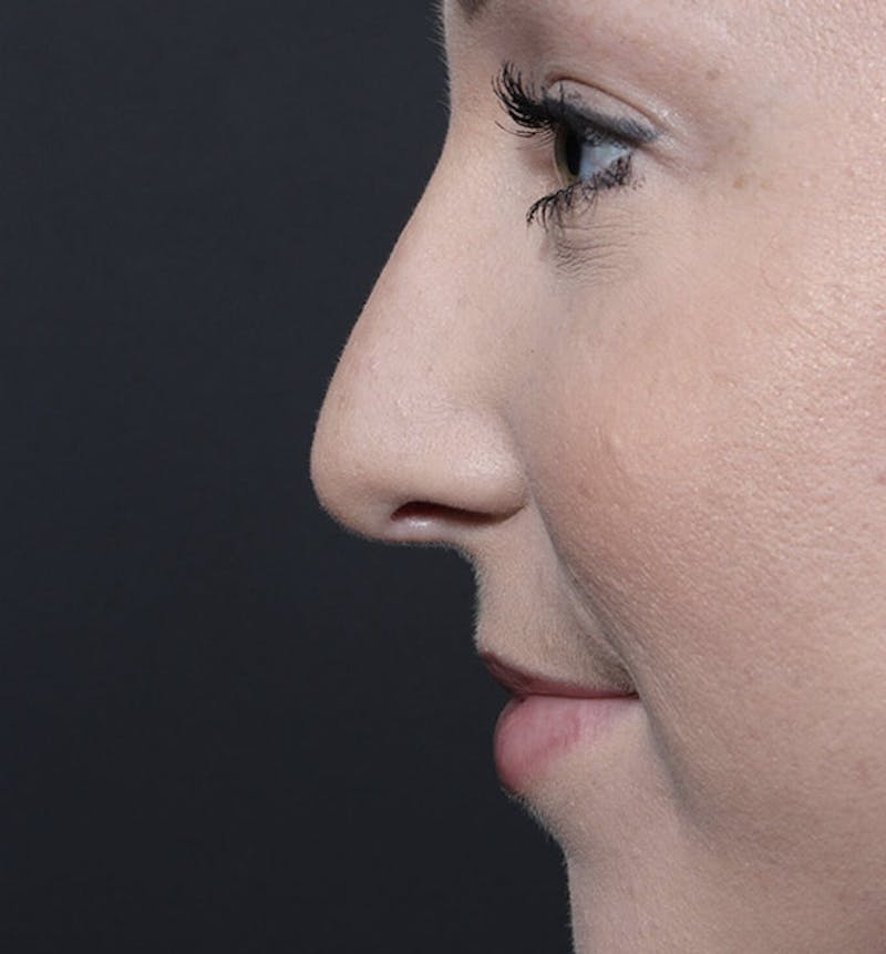 Rhinoplasty Before & After Gallery - Patient 366808 - Image 6