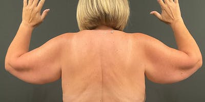 Arm Lift Before & After Gallery - Patient 104778 - Image 1