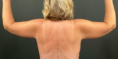 Arm Lift Before & After Gallery - Patient 104778 - Image 2