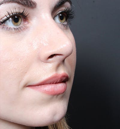 Rhinoplasty Before & After Gallery - Patient 735203 - Image 2