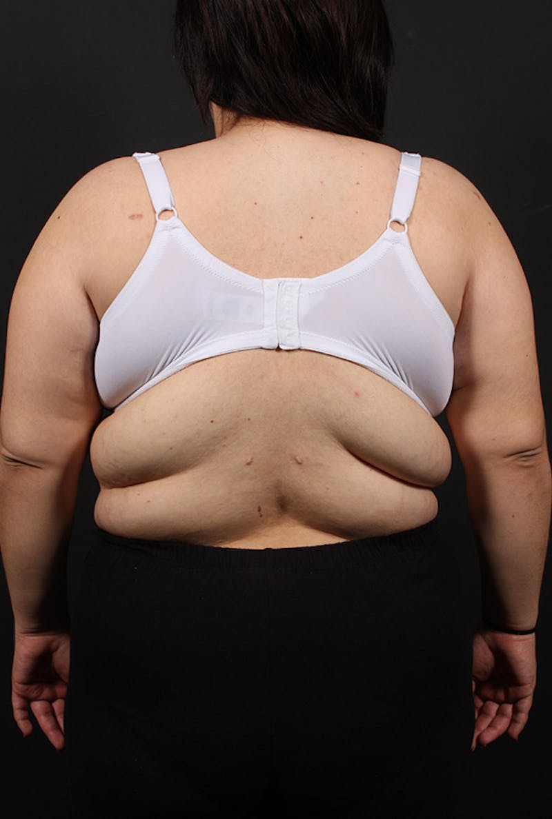 Liposuction Before & After Gallery - Patient 166594 - Image 3