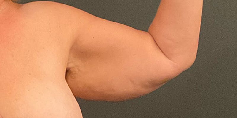 Arm Lift Before & After Gallery - Patient 104778 - Image 3