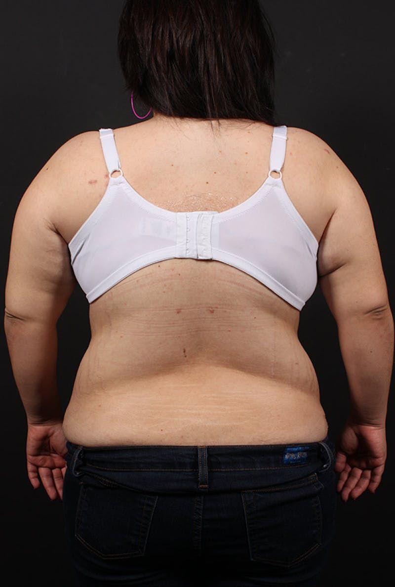 Liposuction Before & After Gallery - Patient 166594 - Image 4