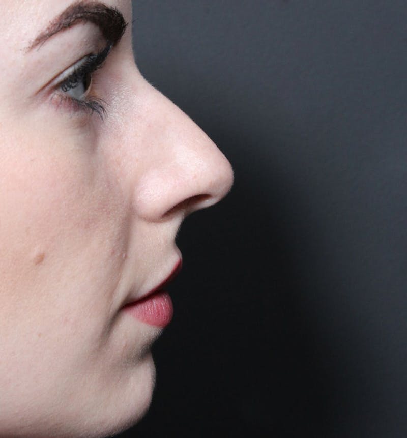 Rhinoplasty Before & After Gallery - Patient 735203 - Image 5