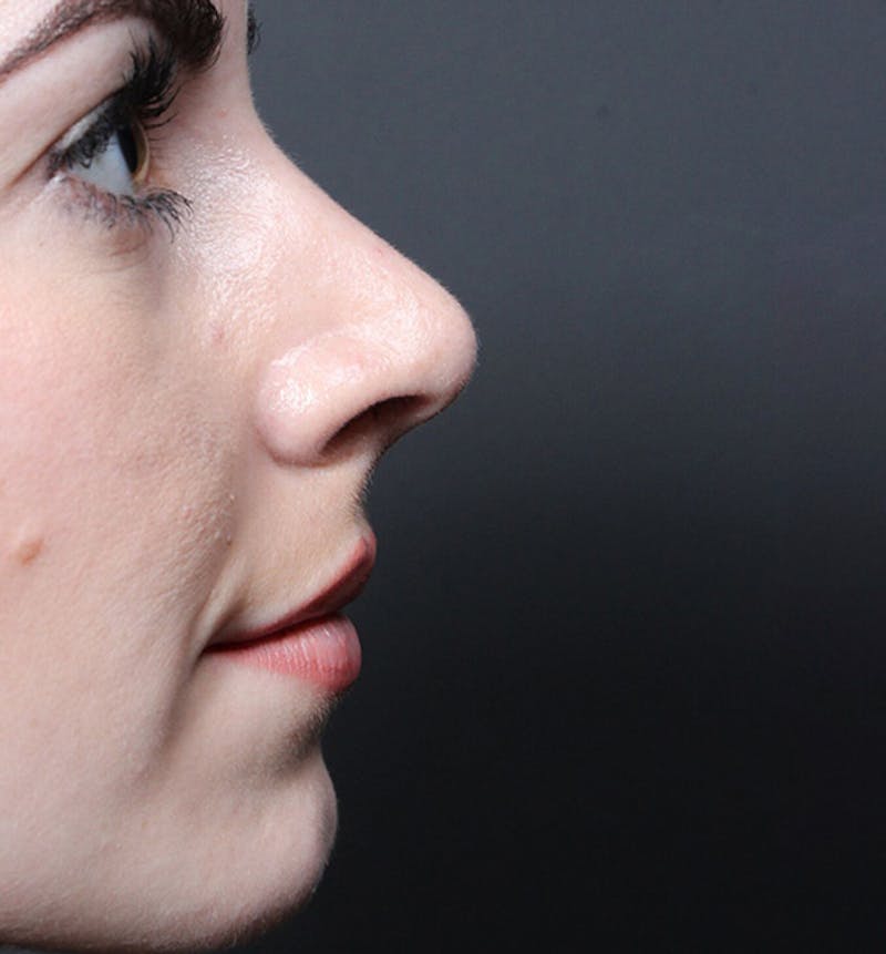 Rhinoplasty Before & After Gallery - Patient 735203 - Image 6