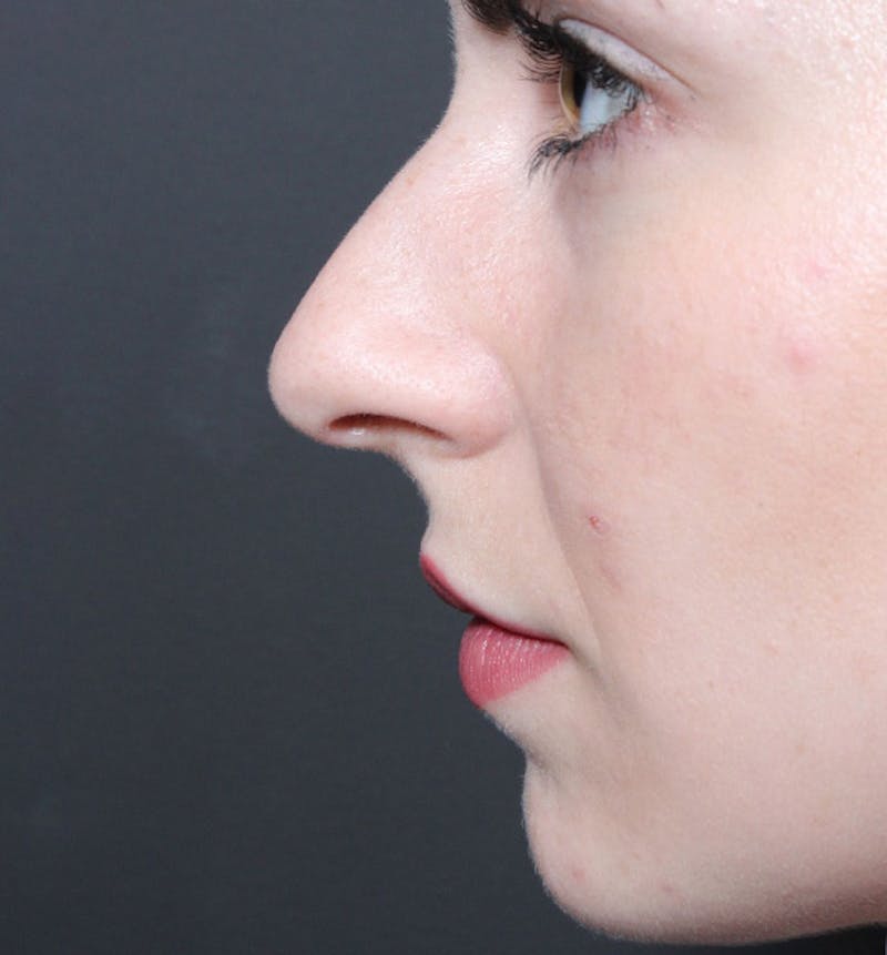 Rhinoplasty Before & After Gallery - Patient 735203 - Image 7