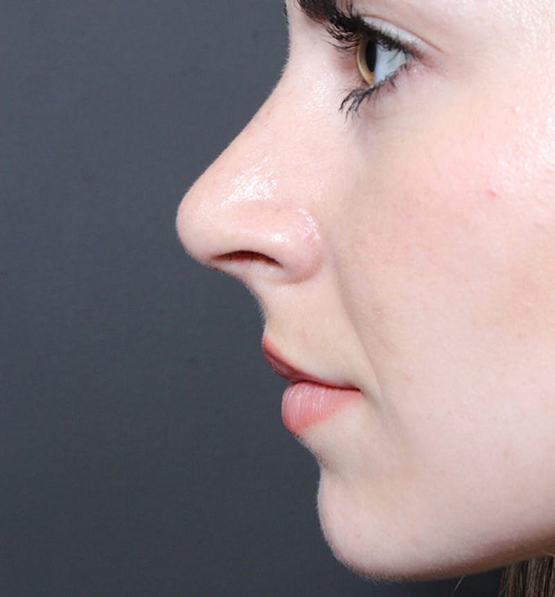 Rhinoplasty Before & After Gallery - Patient 735203 - Image 8