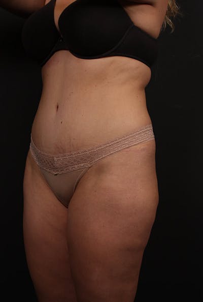 Liposuction Before & After Gallery - Patient 241267 - Image 1