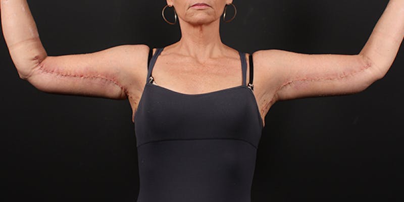 Arm Lift Before & After Gallery - Patient 244222 - Image 4