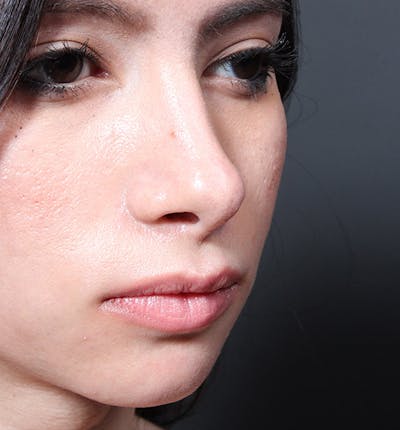 Rhinoplasty Before & After Gallery - Patient 322657 - Image 2