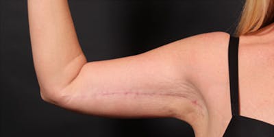 Arm Lift Before & After Gallery - Patient 302262 - Image 2
