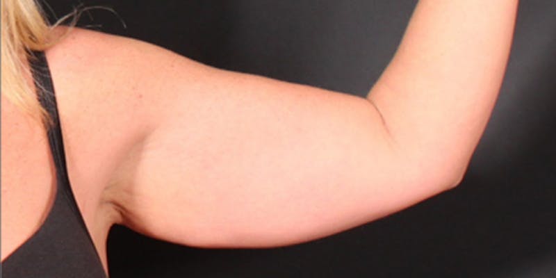 Arm Lift Before & After Gallery - Patient 302262 - Image 3