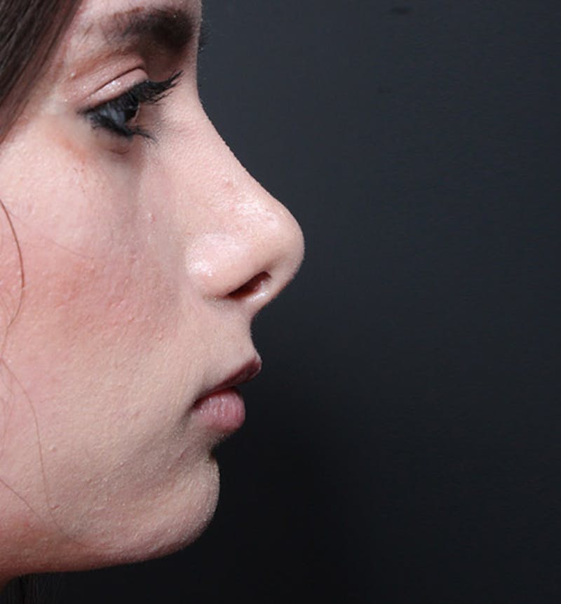 Rhinoplasty Before & After Gallery - Patient 322657 - Image 5