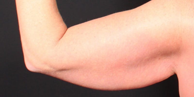 Arm Lift Before & After Gallery - Patient 302262 - Image 5