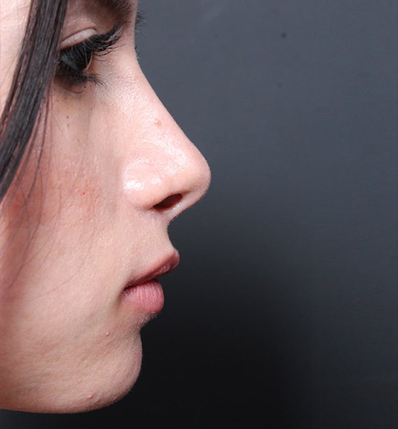 Rhinoplasty Before & After Gallery - Patient 322657 - Image 6