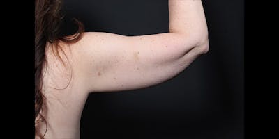 Arm Lift Before & After Gallery - Patient 379120 - Image 1