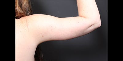 Arm Lift Before & After Gallery - Patient 379120 - Image 2