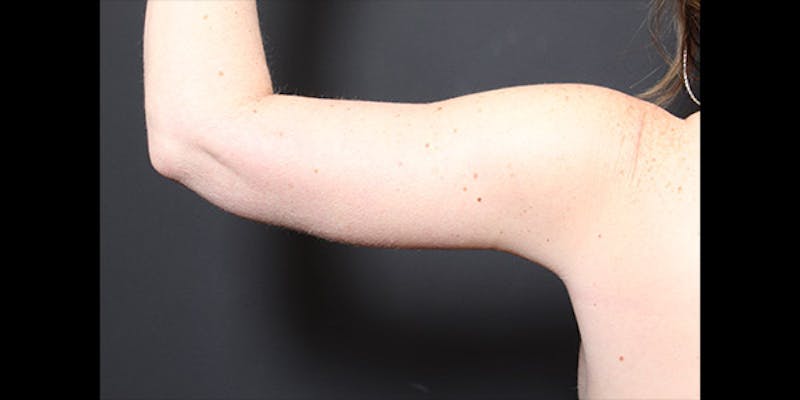 Arm Lift Before & After Gallery - Patient 379120 - Image 4