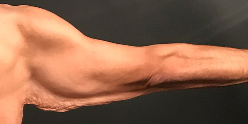 Arm Lift Before & After Gallery - Patient 316458 - Image 1
