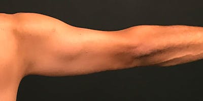 Arm Lift Before & After Gallery - Patient 316458 - Image 2
