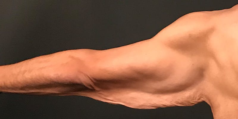 Arm Lift Before & After Gallery - Patient 316458 - Image 3