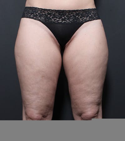 Liposuction Before & After Gallery - Patient 216874 - Image 1