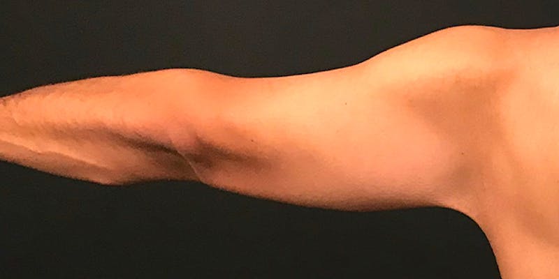 Arm Lift Before & After Gallery - Patient 316458 - Image 4