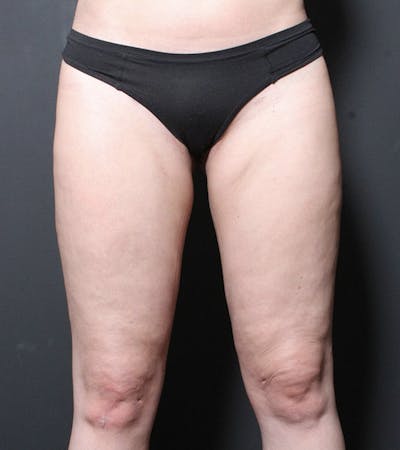 Liposuction Before & After Gallery - Patient 216874 - Image 2