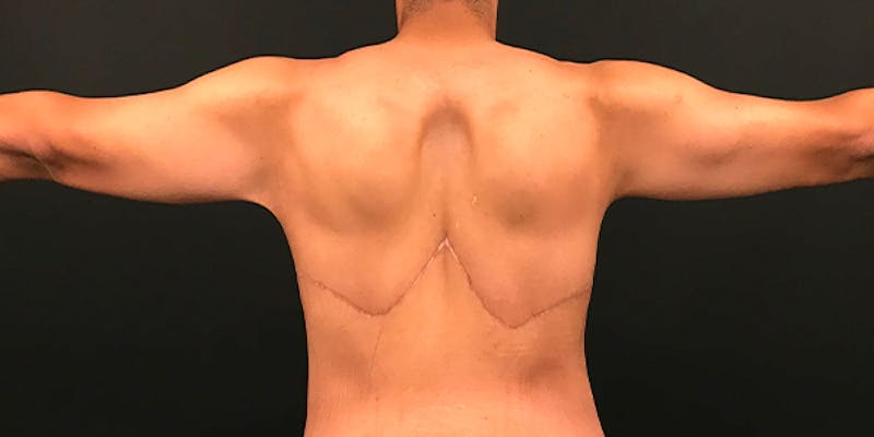 Arm Lift Before & After Gallery - Patient 316458 - Image 6