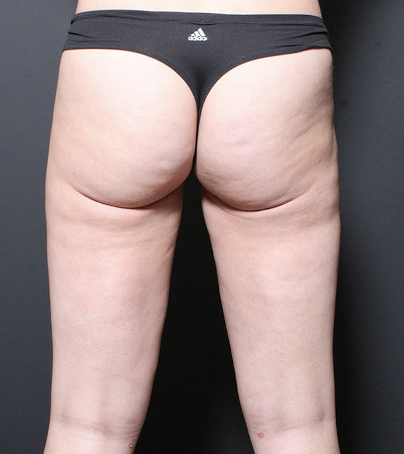 Liposuction Before & After Gallery - Patient 216874 - Image 4
