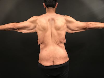 Arm Lift Before & After Gallery - Patient 353224 - Image 1