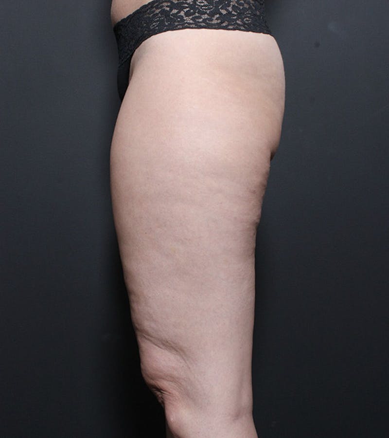 Liposuction Before & After Gallery - Patient 216874 - Image 5