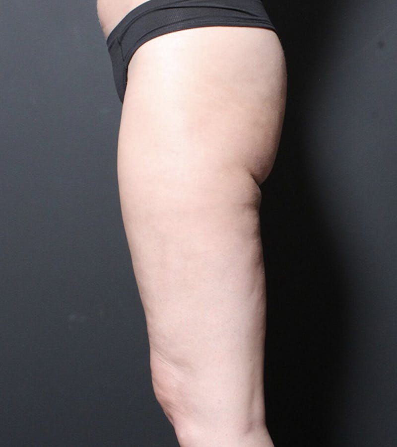 Liposuction Before & After Gallery - Patient 216874 - Image 6