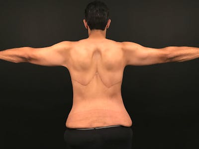Arm Lift Before & After Gallery - Patient 353224 - Image 2