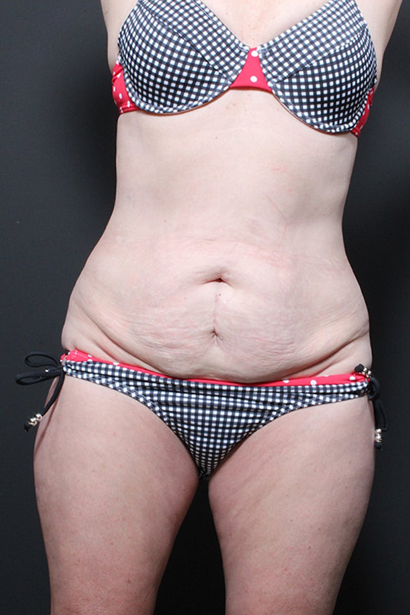 Liposuction Before & After Gallery - Patient 266199 - Image 3
