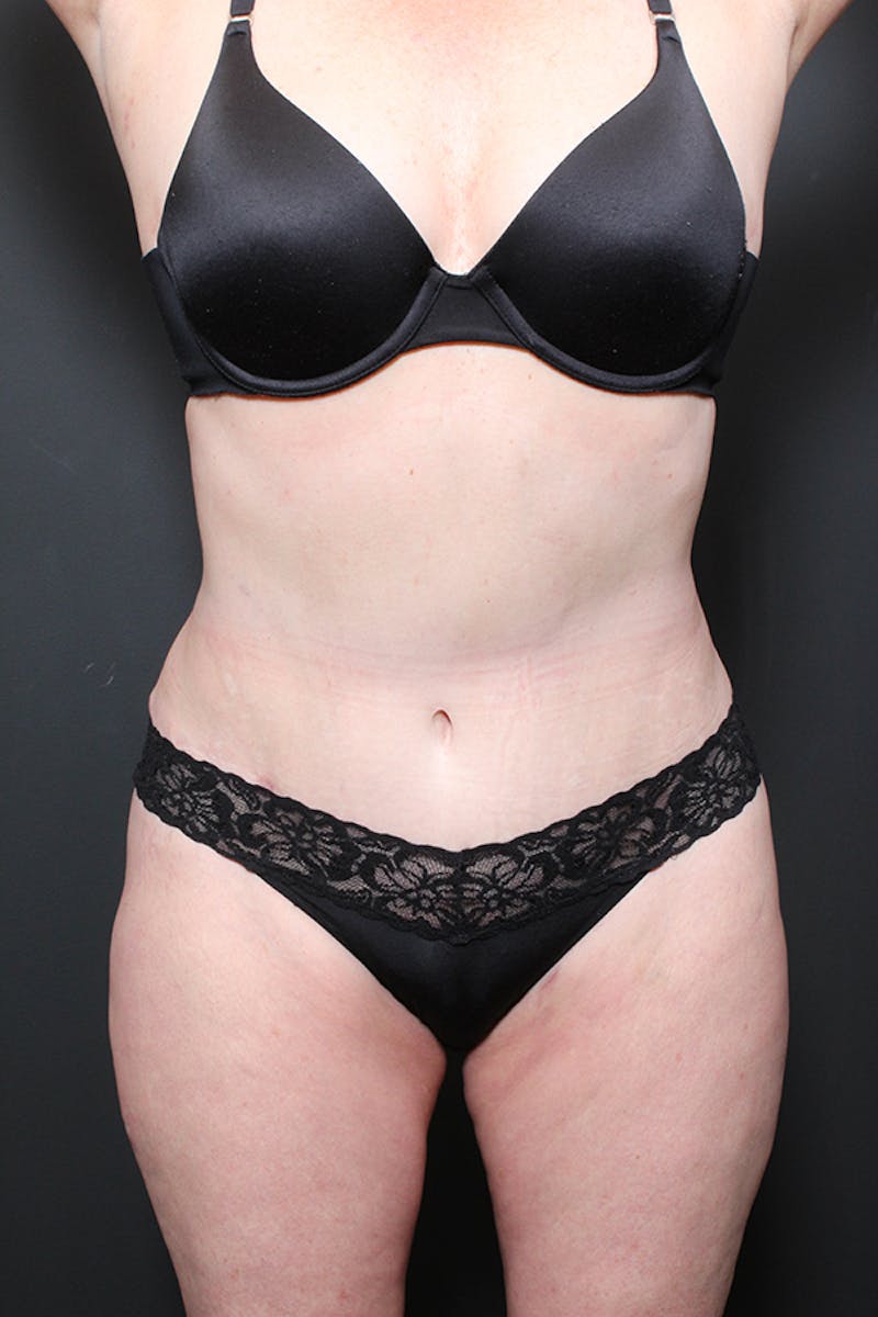 Liposuction Before & After Gallery - Patient 266199 - Image 4