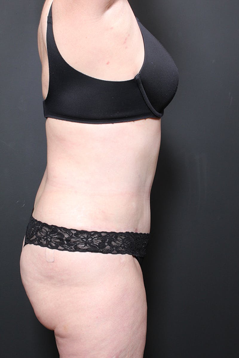 Liposuction Before & After Gallery - Patient 266199 - Image 6
