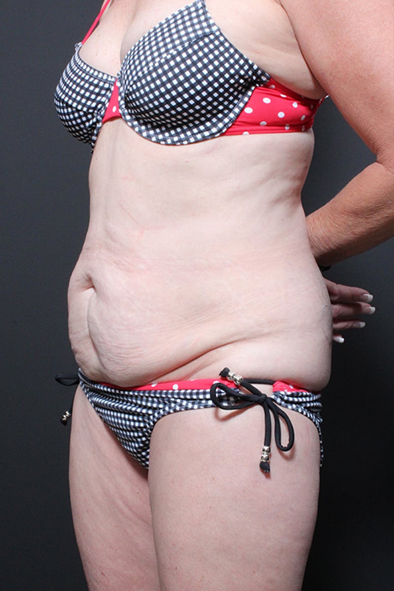 Liposuction Before & After Gallery - Patient 266199 - Image 7