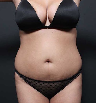 Liposuction Before & After Gallery - Patient 255839 - Image 1