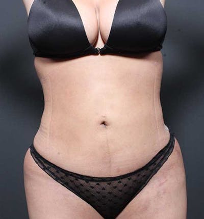 Liposuction Before & After Gallery - Patient 255839 - Image 2
