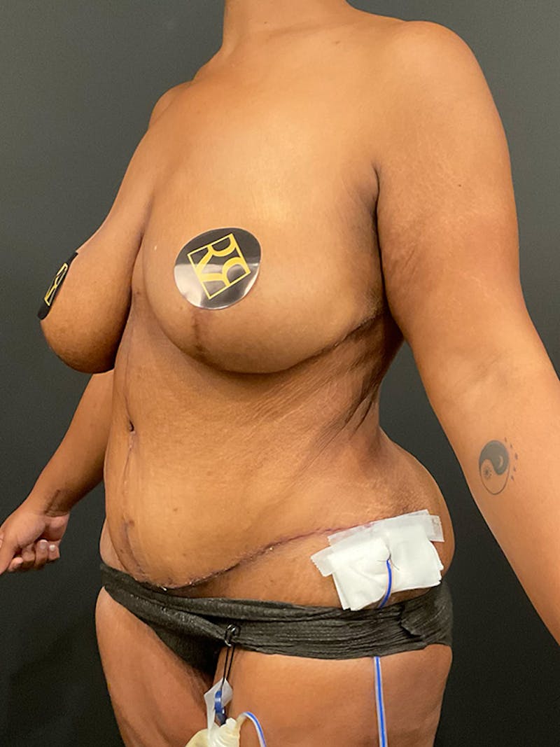 Tummy Tuck Before & After Gallery - Patient 139135 - Image 4