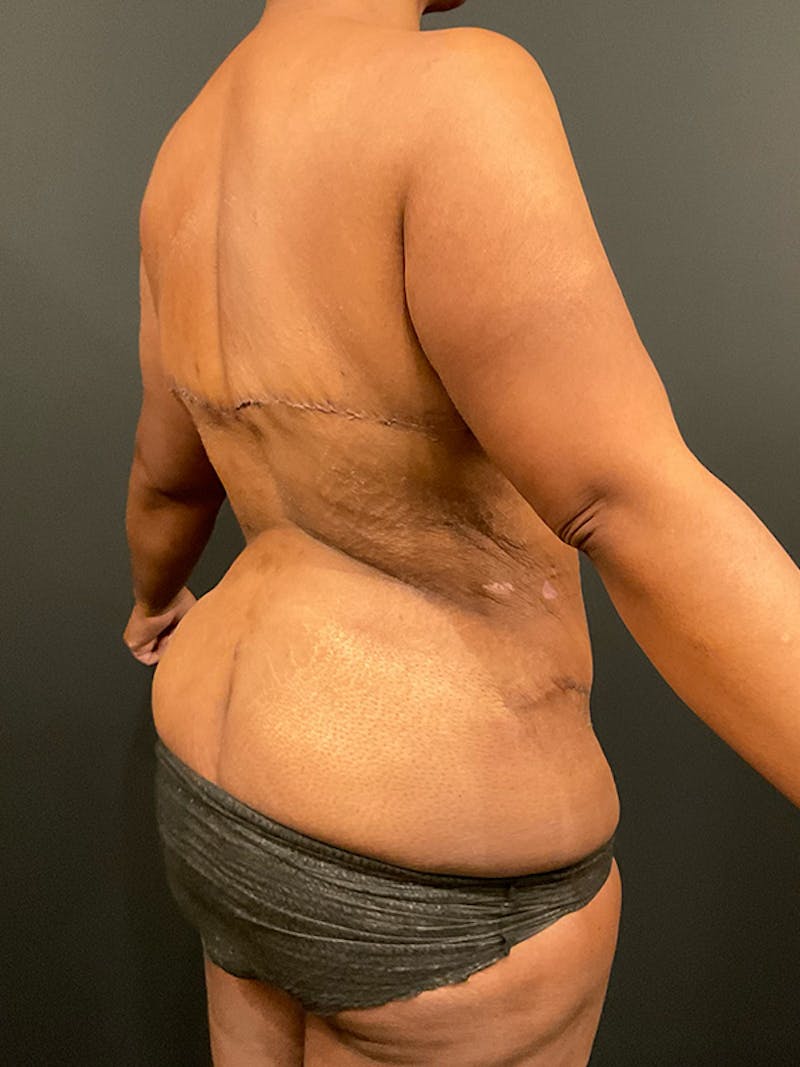 Tummy Tuck Before & After Gallery - Patient 139135 - Image 8