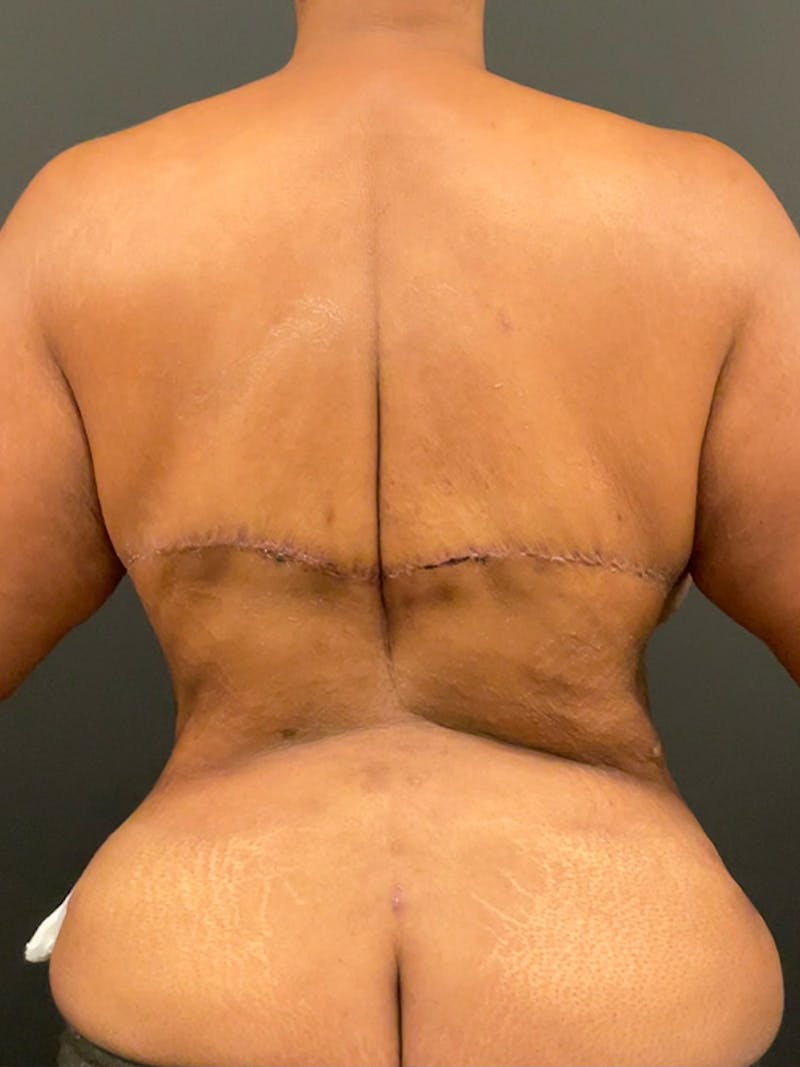 Tummy Tuck Before & After Gallery - Patient 139135 - Image 10