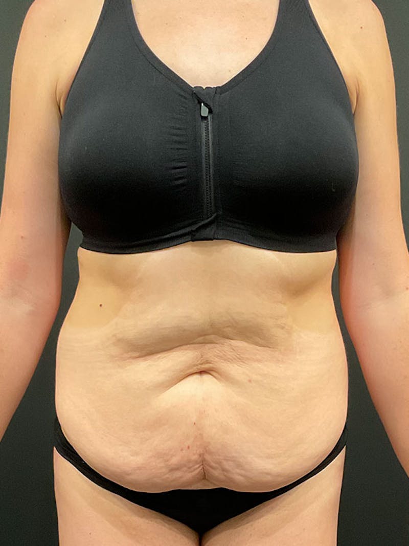 Tummy Tuck Before & After Gallery - Patient 332222 - Image 1